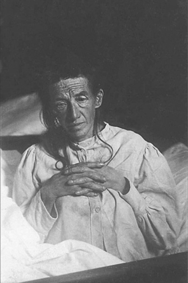 Auguste Deter, die erste Patientin von Alois Alzheimer